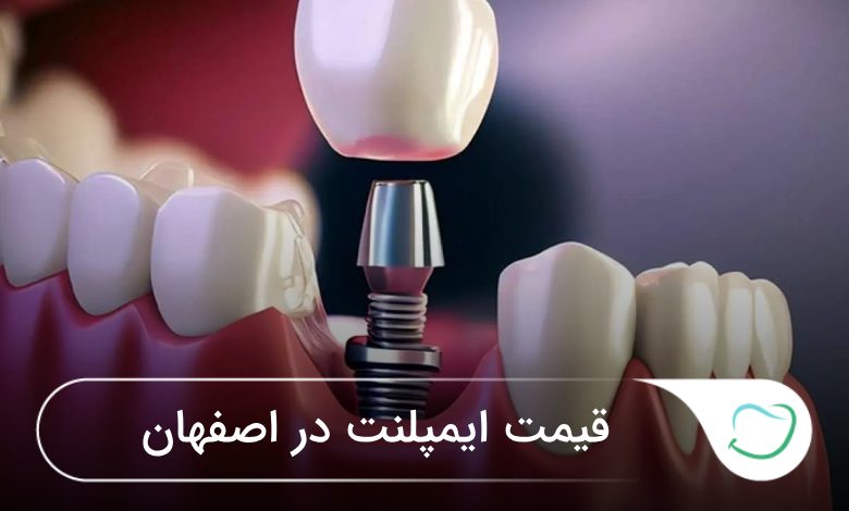 قیمت ایمپلنت در اصفهان🦷【بهروز رسانیسال1405】❤️ قیمت ایمپلنت در اصفهان🦷【بهروز رسانیسال1405】❤️