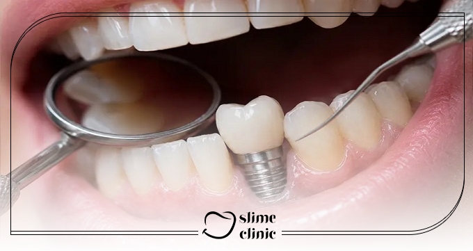 ویژگی های بهترین مرکز ایمپلنت در اصفهان