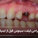 جراحی لیفت سینوس قبل از ایمپلنت دندان🦷【بهروزرسانی1405】❤️ جراحی لیفت سینوس قبل از ایمپلنت دندان🦷【بهروزرسانی1405】❤️