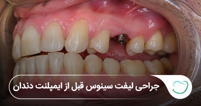 جراحی لیفت سینوس قبل از ایمپلنت دندان🦷【بهروزرسانی1405】❤️ جراحی لیفت سینوس قبل از ایمپلنت دندان🦷【بهروزرسانی1405】❤️