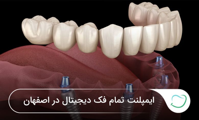 ایمپلنت تمام فک دیجیتال در اصفهان 🦷【آپدیتسال1405】❤️ ایمپلنت تمام فک دیجیتال در اصفهان 🦷【آپدیتسال1405】❤️