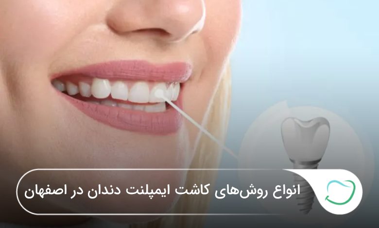 انواع روشهای کاشت ایمپلنت دندان در اصفهان🦷【آپدیتسال1405】⭐ انواع روشهای کاشت ایمپلنت دندان در اصفهان🦷【آپدیتسال1405】⭐