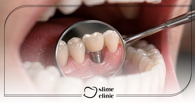 چه شرایطی برای انجام ایمپلنت پانچ مناسب است؟