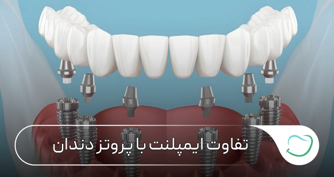 تفاوت ایمپلنت با پروتز دندان 🦷【سال1405】✅ تفاوت ایمپلنت با پروتز دندان 🦷【سال1405】✅