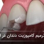 ترمیم کامپوزیت دندان در اصفهان🦷【آپدیتسال1405】❤️ ترمیم کامپوزیت دندان در اصفهان🦷【آپدیتسال1405】❤️