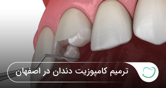 ترمیم کامپوزیت دندان در اصفهان🦷【آپدیتسال1405】❤️ ترمیم کامپوزیت دندان در اصفهان🦷【آپدیتسال1405】❤️