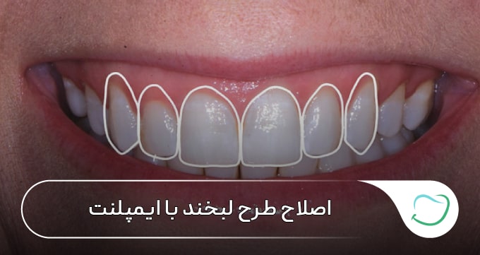 اصلاح طرح لبخند با ایمپلنت 🦷【سال1405】✅ اصلاح طرح لبخند با ایمپلنت 🦷【سال1405】✅