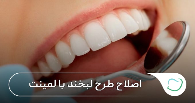 اصلاح طرح لبخند با لمینت 🦷【سال1405】⚡ اصلاح طرح لبخند با لمینت 🦷【سال1405】⚡
