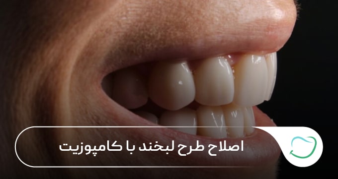اصلاح طرح لبخند با کامپوزیت 🦷【سال1405】💗 اصلاح طرح لبخند با کامپوزیت 🦷【سال1405】💗