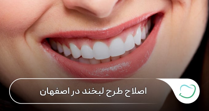 اصلاح طرح لبخند در اصفهان 🦷【سال1405】⭐ اصلاح طرح لبخند در اصفهان 🦷【سال1405】⭐