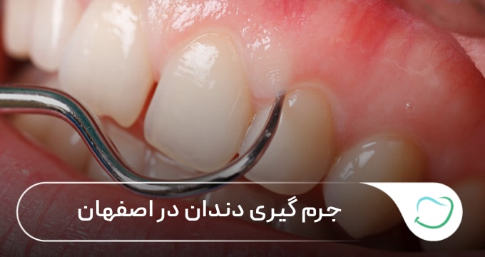 جرم گیری دندان در اصفهان 🦷【سال1405】⭐ جرم گیری دندان در اصفهان 🦷【سال1405】⭐