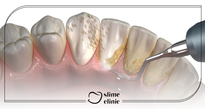 جرمگیری دندان چیست و چه ضرورتی دارد؟