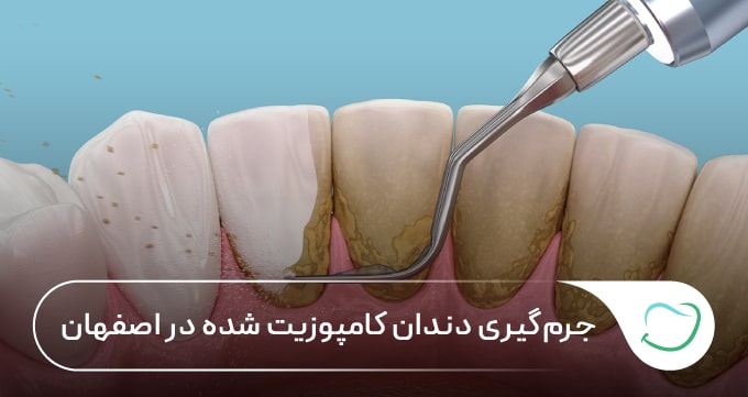 جرمگیری دندان کامپوزیت شده در اصفهان 🦷【سال1405】✅ جرمگیری دندان کامپوزیت شده در اصفهان 🦷【سال1405】✅