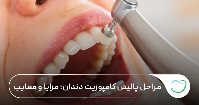 مراحل پالیش کامپوزیت دندان؛ مزایا و معایب 🦷【سال1405】⚡ مراحل پالیش کامپوزیت دندان؛ مزایا و معایب 🦷【سال1405】⚡