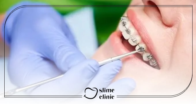 چرا همه به دنبال جایگزین ارتودنسی هستند؟