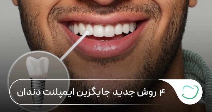 ۴ روش جدید جایگزین ایمپلنت دندان 🦷【سال1405】💗 ۴ روش جدید جایگزین ایمپلنت دندان 🦷【سال1405】💗