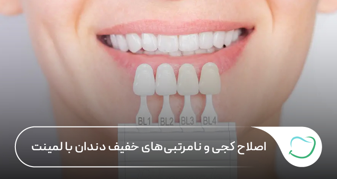 اصلاح کجی و نامرتبیهای خفیف دندان با لمینت 🦷【سال1405】✅ اصلاح کجی و نامرتبیهای خفیف دندان با لمینت 🦷【سال1405】✅