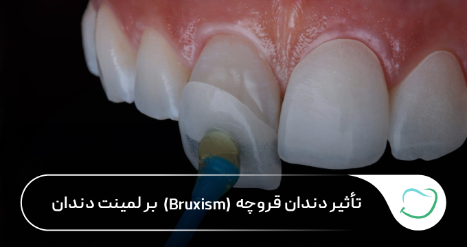 تأثیر دندان قروچه (Bruxism) بر لمینت دندان 🦷【سال1405】⭐ تأثیر دندان قروچه (Bruxism) بر لمینت دندان 🦷【سال1405】⭐
