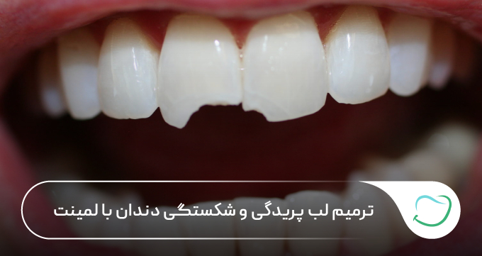 ترمیم لب پریدگی و شکستگی دندان با لمینت 🦷【سال1405】✅ ترمیم لب پریدگی و شکستگی دندان با لمینت 🦷【سال1405】✅