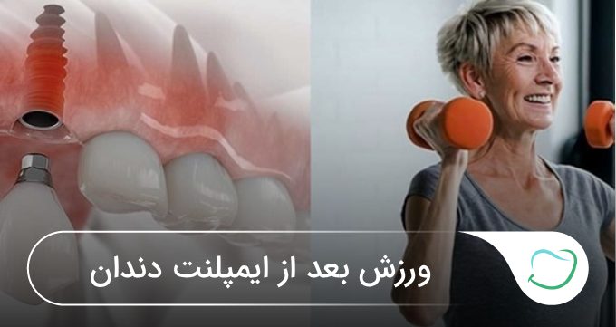 ورزش بعد از ایمپلنت دندان🦷【بهروزرسانی سال1405】✅ ورزش بعد از ایمپلنت دندان🦷【بهروزرسانی سال1405】✅
