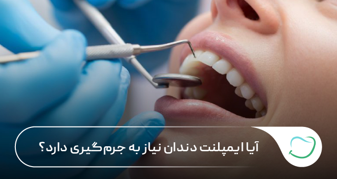 آیا ایمپلنت دندان نیاز به جرمگیری دارد؟ 🦷【سال1405】⭐ آیا ایمپلنت دندان نیاز به جرمگیری دارد؟ 🦷【سال1405】⭐