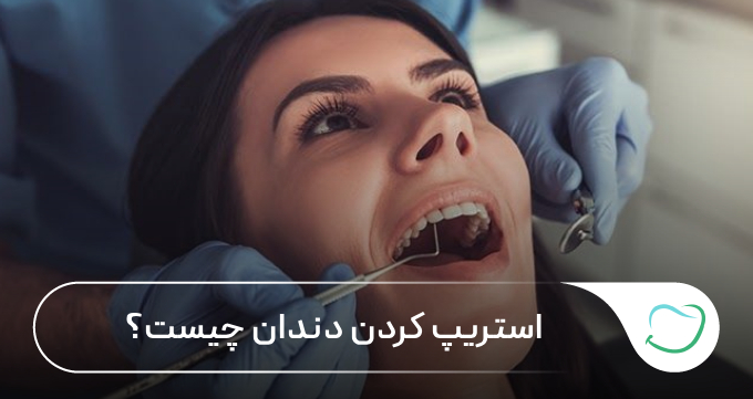 استریپ کردن دندان چیست؟ 🦷【سال1405】⭐ استریپ کردن دندان چیست؟ 🦷【سال1405】⭐