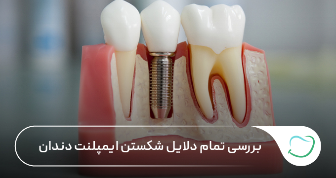 بررسی تمام دلایل شکستن ایمپلنت دندان 🦷【سال1405】⭐ بررسی تمام دلایل شکستن ایمپلنت دندان 🦷【سال1405】⭐