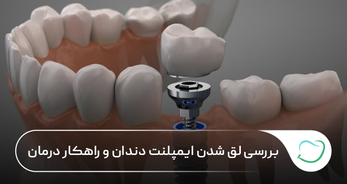 بررسی لق شدن ایمپلنت دندان و راهکار درمان 🦷【سال1405】⭐ بررسی لق شدن ایمپلنت دندان و راهکار درمان 🦷【سال1405】⭐