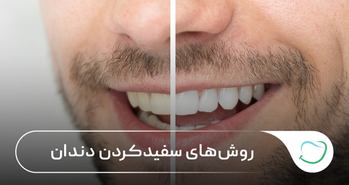 روشهای سفیدکردن دندان 🦷【سال1405】💗 روشهای سفیدکردن دندان 🦷【سال1405】💗