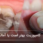 کامپوزیت بهتر است یا آمالگام؟ 🦷❤️ کامپوزیت بهتر است یا آمالگام؟ 🦷❤️