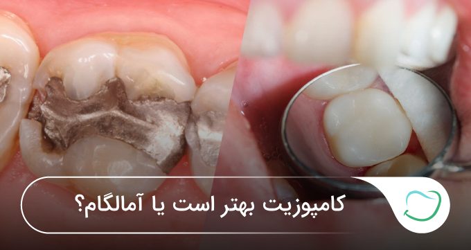کامپوزیت بهتر است یا آمالگام؟ 🦷❤️ کامپوزیت بهتر است یا آمالگام؟ 🦷❤️