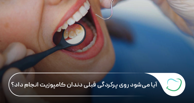 آیا میشود روی دندان پر شده کامپوزیت انجام داد؟ 🦷 آیا میشود روی دندان پر شده کامپوزیت انجام داد؟ 🦷