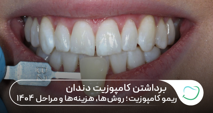 برداشتن کامپوزیت دندان | ریمو کامپوزیت؛ روشها، هزینهها و مراحل 🦷 برداشتن کامپوزیت دندان | ریمو کامپوزیت؛ روشها، هزینهها و مراحل 🦷
