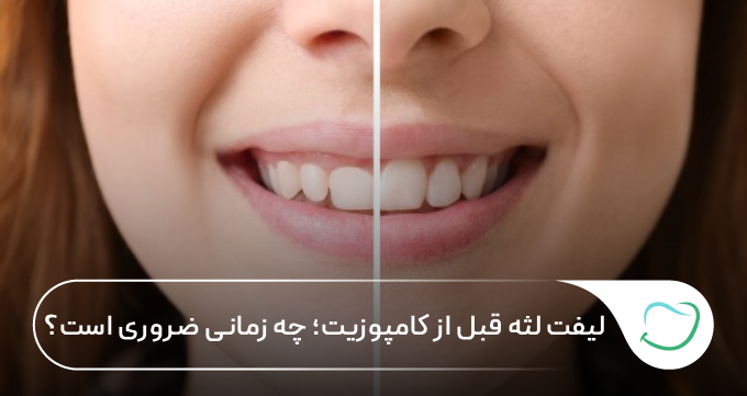 لیفت لثه قبل از کامپوزیت؛ چه زمانی ضروری است؟ (راهنمای ۱۴۰۵) 🦷 لیفت لثه قبل از کامپوزیت؛ چه زمانی ضروری است؟ (راهنمای ۱۴۰۵) 🦷