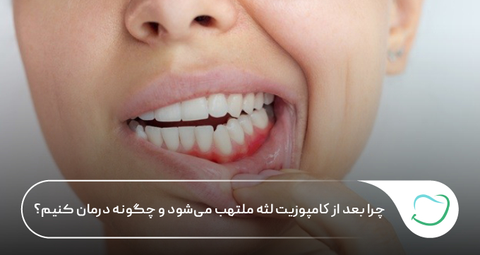 چرا بعد از کامپوزیت لثه ملتهب میشود و چگونه درمان کنیم؟ 🦷 ⚡ چرا بعد از کامپوزیت لثه ملتهب میشود و چگونه درمان کنیم؟ 🦷 ⚡