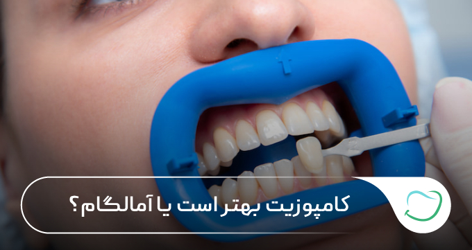 کامپوزیت بهتر است یا آمالگام؟ 🦷 💗 کامپوزیت بهتر است یا آمالگام؟ 🦷 💗