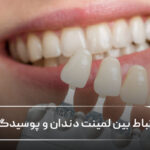 ارتباط بین لمینت دندان و پوسیدگی دندان 🦷✅ ارتباط بین لمینت دندان و پوسیدگی دندان 🦷✅