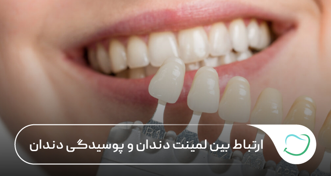 ارتباط بین لمینت دندان و پوسیدگی دندان 🦷✅ ارتباط بین لمینت دندان و پوسیدگی دندان 🦷✅