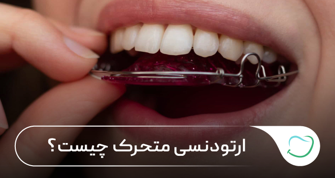 ارتودنسی متحرک چیست؟ 🦷⭐ ارتودنسی متحرک چیست؟ 🦷⭐