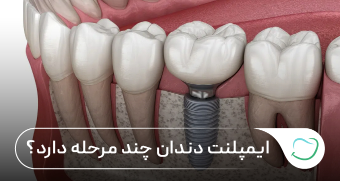 ایمپلنت دندان چند مرحله دارد؟ بررسی کامل مراحل ایمپلنت 🦷✅ ایمپلنت دندان چند مرحله دارد؟ بررسی کامل مراحل ایمپلنت 🦷✅