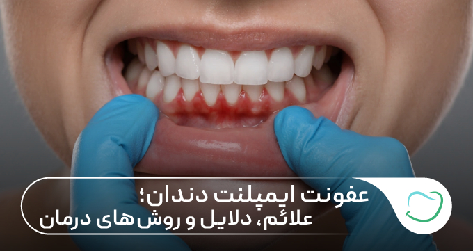 عفونت ایمپلنت دندان؛ علائم، دلایل و روشهای درمان 🦷✅ عفونت ایمپلنت دندان؛ علائم، دلایل و روشهای درمان 🦷✅