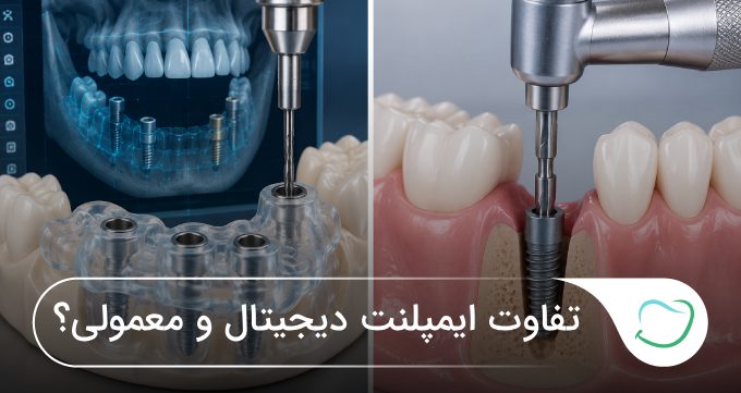 تفاوت ایمپلنت دیجیتال و معمولی؛ کدام روش برای کاشت دندان بهتر است؟ 🦷 تفاوت ایمپلنت دیجیتال و معمولی؛ کدام روش برای کاشت دندان بهتر است؟ 🦷