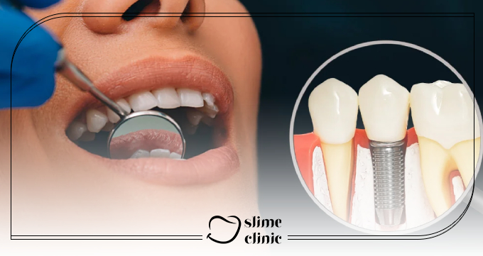 کدام مرحله ایمپلنت دردناکتر است؟ از جراحی تا روکش