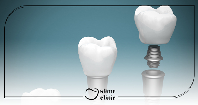 اباتمنتهای تیتانیومی
