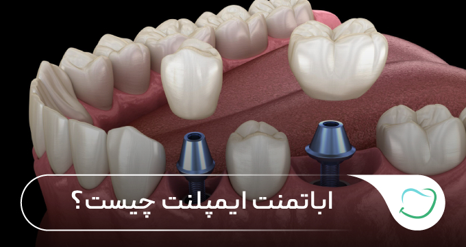 اباتمنت ایمپلنت چیست؟ 🦷⭐ اباتمنت ایمپلنت چیست؟ 🦷⭐
