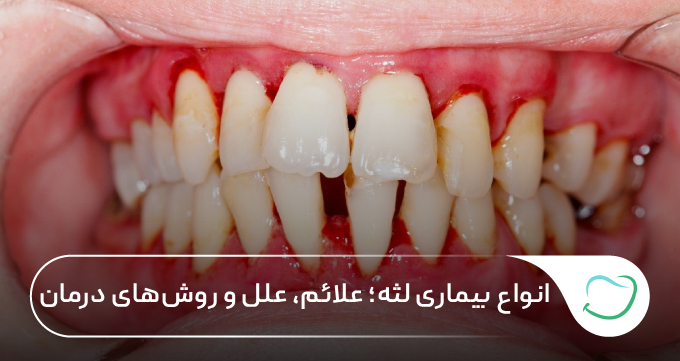 انواع بیماری لثه؛ علائم، علل و روشهای درمان 🦷✅ انواع بیماری لثه؛ علائم، علل و روشهای درمان 🦷✅