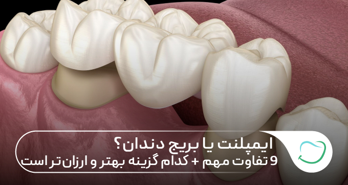ایمپلنت یا بریج دندان؟ ۹ تفاوت مهم + کدام گزینه بهتر و ارزانتر است 🦷✅ ایمپلنت یا بریج دندان؟ ۹ تفاوت مهم + کدام گزینه بهتر و ارزانتر است 🦷✅