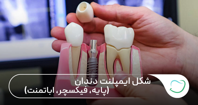 شکل ایمپلنت دندان: (پایه، فیکسچر، اباتمنت) 🦷⚡ شکل ایمپلنت دندان: (پایه، فیکسچر، اباتمنت) 🦷⚡