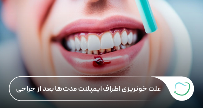 علت خونریزی اطراف ایمپلنت مدتها بعد از جراحی چیست؟ 🦷💗 علت خونریزی اطراف ایمپلنت مدتها بعد از جراحی چیست؟ 🦷💗
