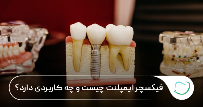 فیکسچر ایمپلنت چیست و چه کاربردی دارد؟ 🦷✅ فیکسچر ایمپلنت چیست و چه کاربردی دارد؟ 🦷✅